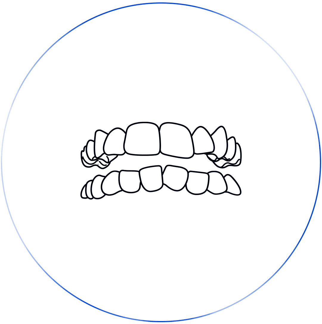 Dentes apinhados